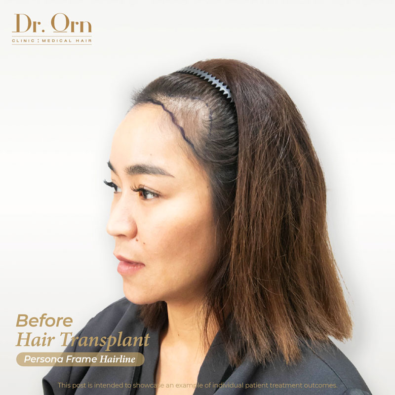 mae june before hair transplant