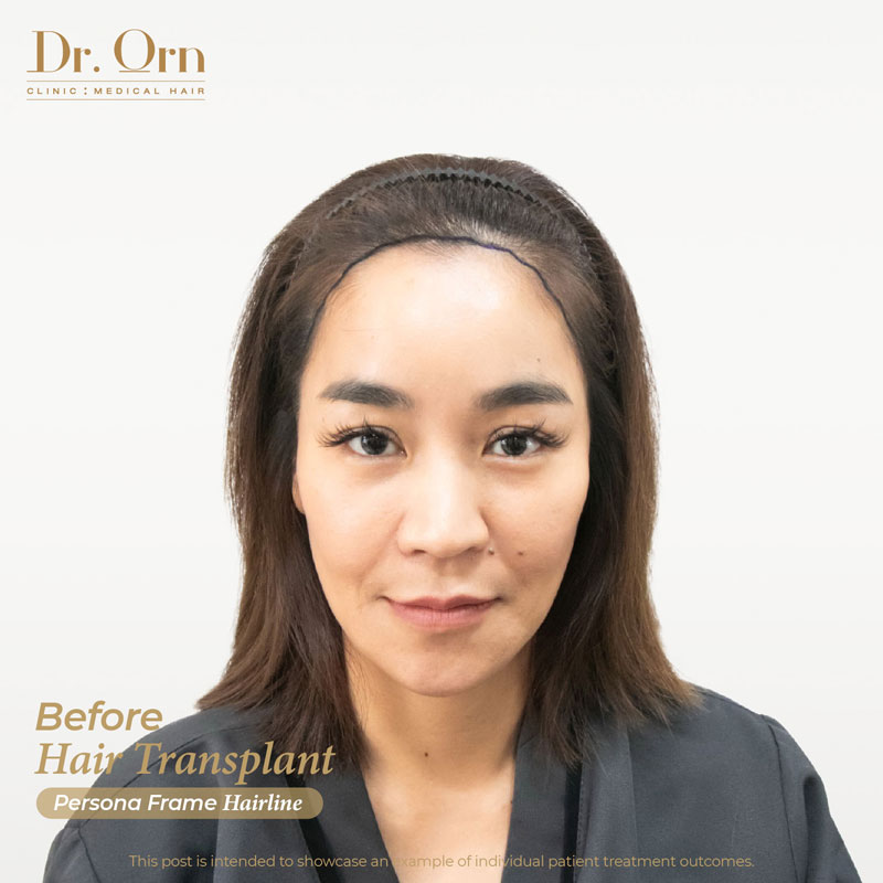 mae june before hair transplant