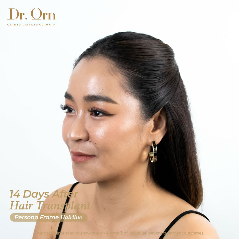 mae june 14 days after hair transplant