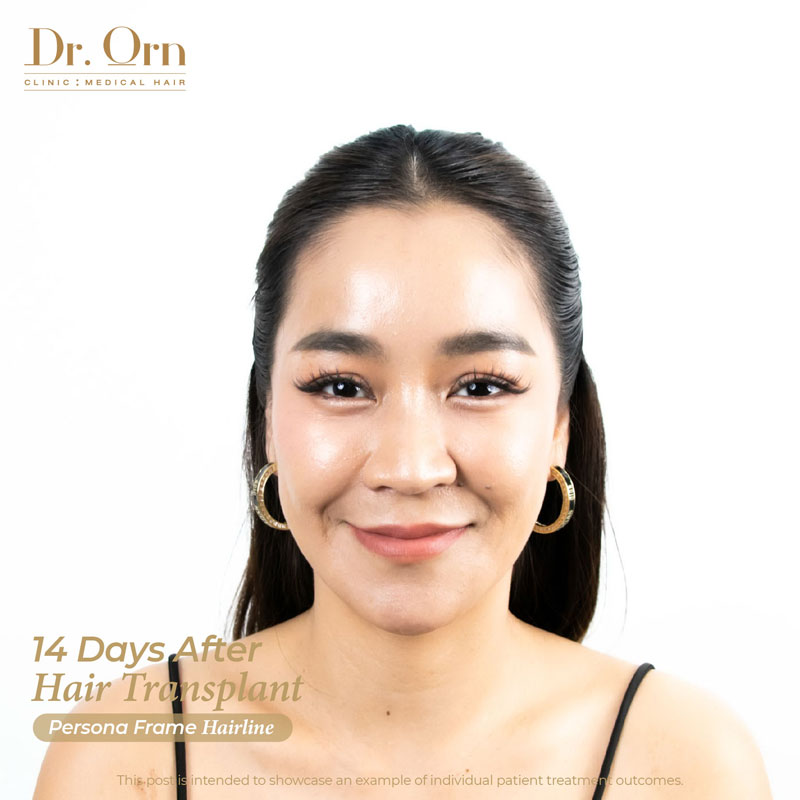 mae june 14 day after hair transplant