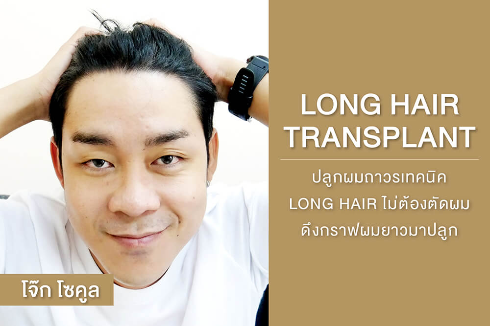 ปลูกผมเทคนิค Long Hair Transplant