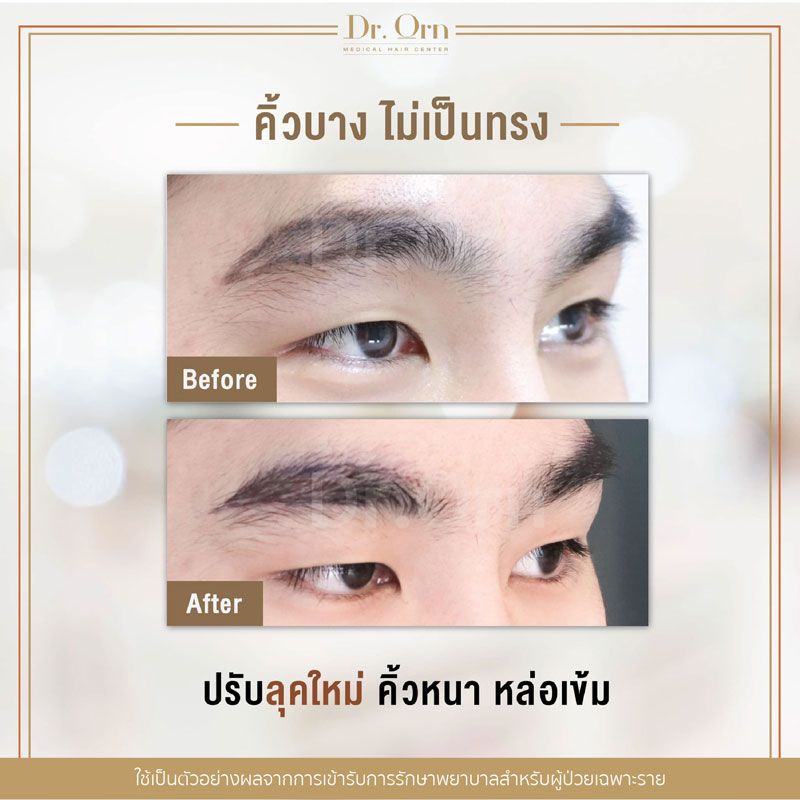 รีวิวปลูกคิ้วผู้ชาย 01