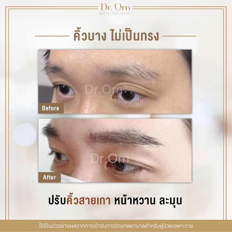 รีวิวปลูกคิ้วผู้ชาย 02