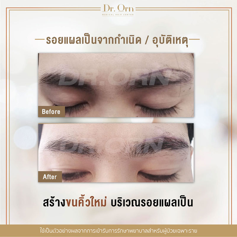 รีวิวปลูกคิ้วผู้ชาย 03