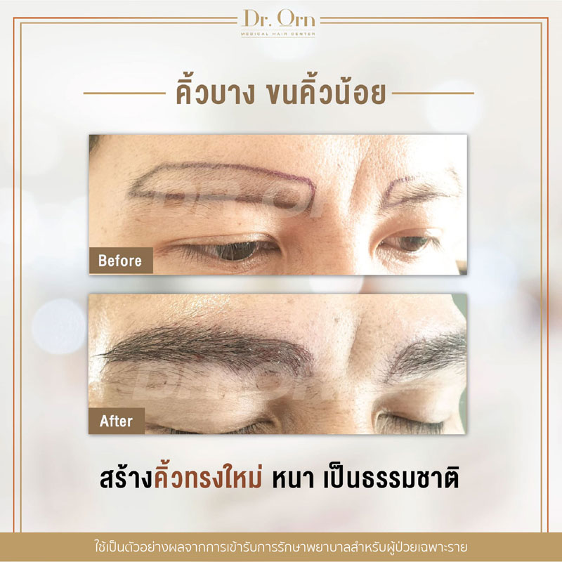 รีวิวปลูกคิ้วผู้ชาย 04