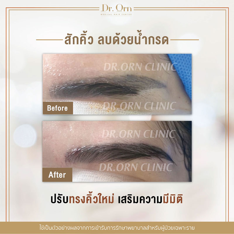 รีวิวปลูกคิ้วผู้หญิง 01