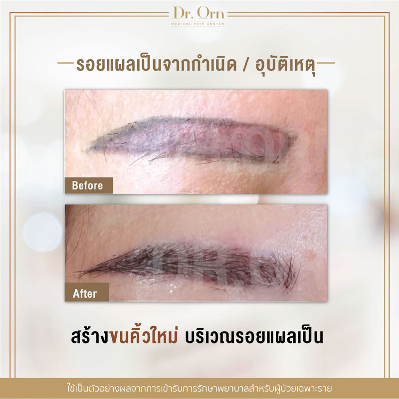 รีวิวปลูกคิ้วผู้หญิง 02