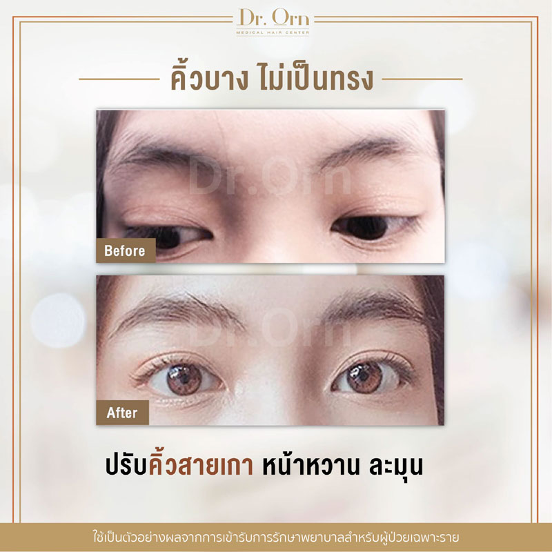 รีวิวปลูกคิ้วผู้หญิง 03