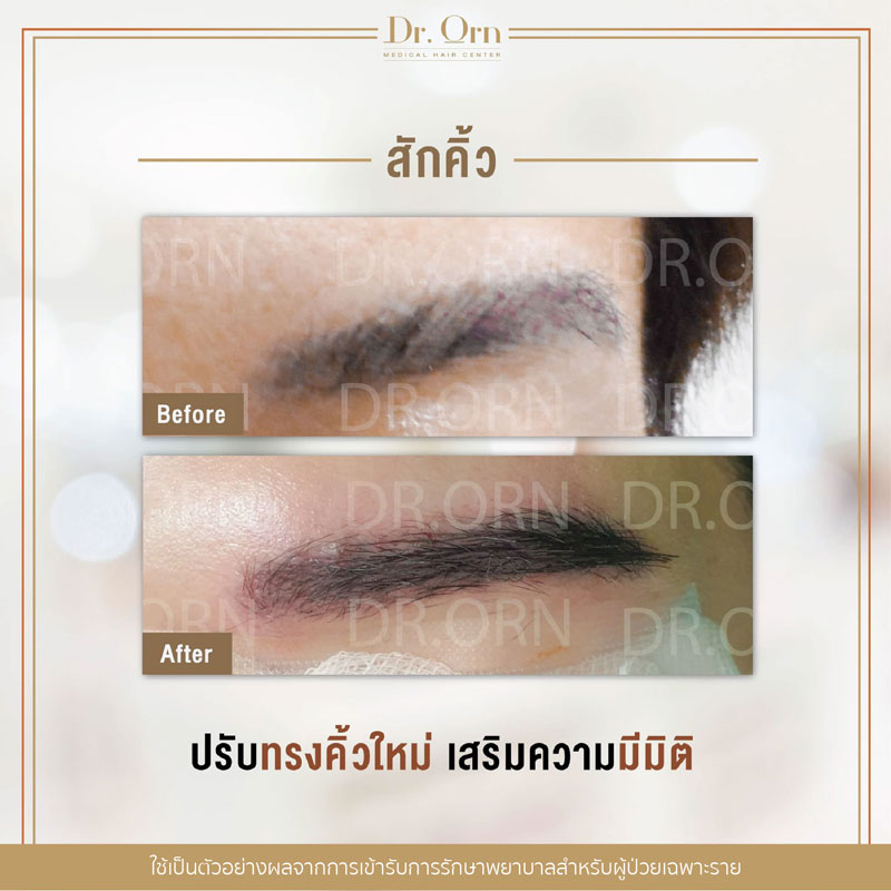 รีวิวปลูกคิ้วผู้หญิง 04