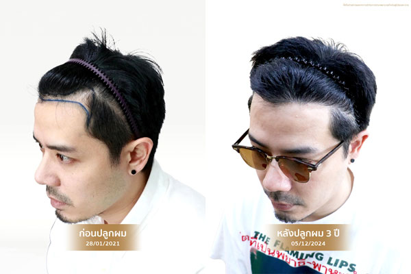 ปลูกผมแก้หัวเถิกในผู้ชาย