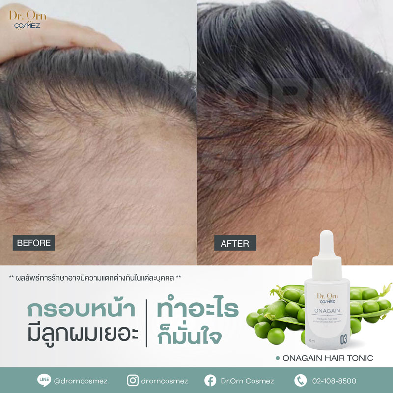 รีวิวเซรั่มปลูกผม