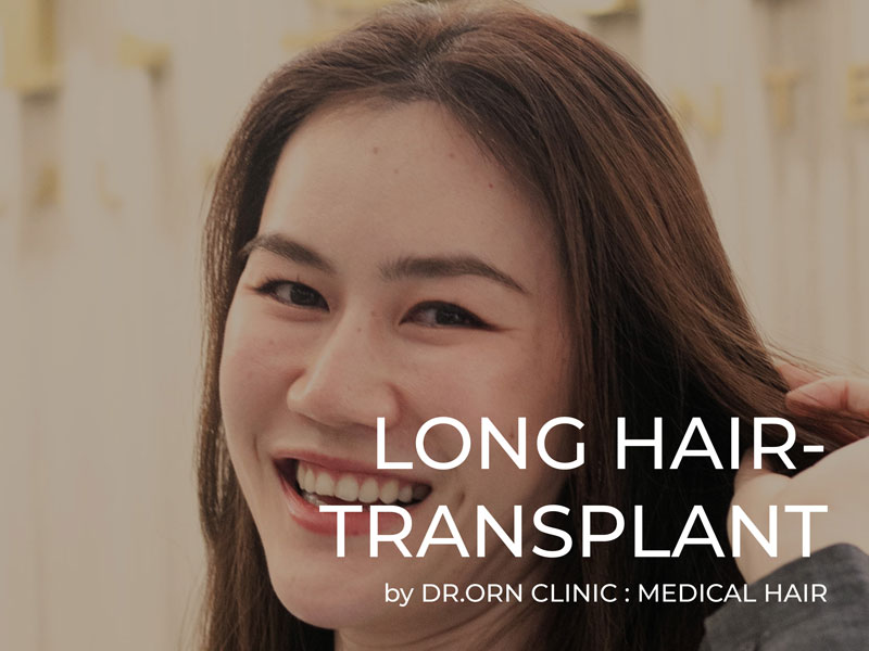 ปลูกผมยาว ปลูกผมถาวรแบบไม่ต้องตัดผม ไม่ต้องโกน เห็นผลทันที! Long hair transplant