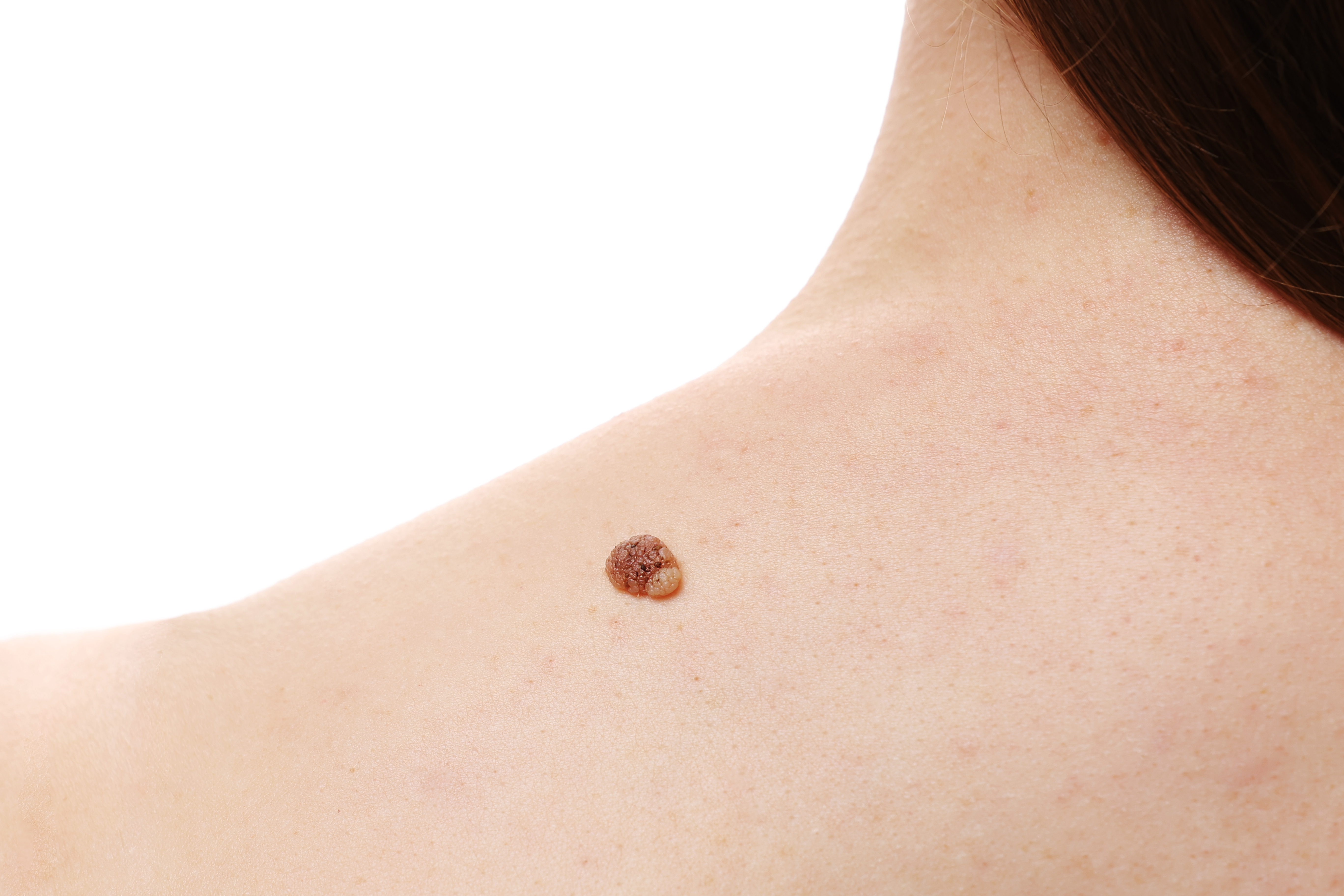 Skin tag, Mole, Wart Removal