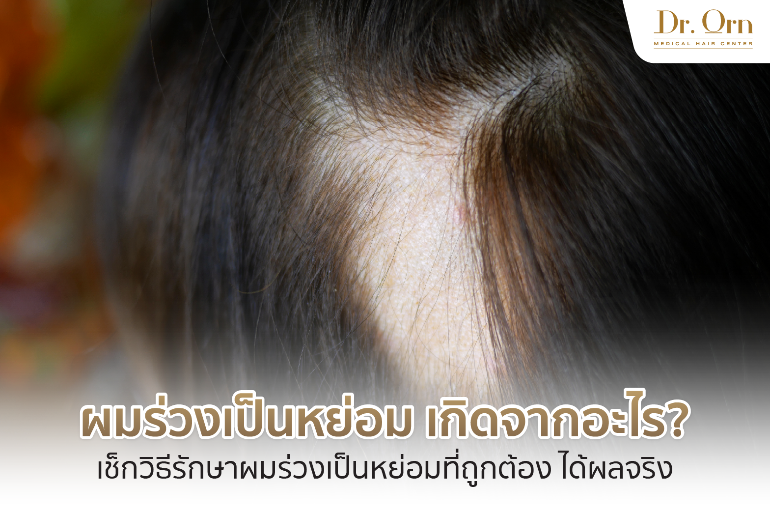 ผมร่วงเป็นหย่อม เกิดจากอะไร? เช็กวิธีรักษาผมร่วงเป็นหย่อมที่ถูกต้อง ได้ผลจริง