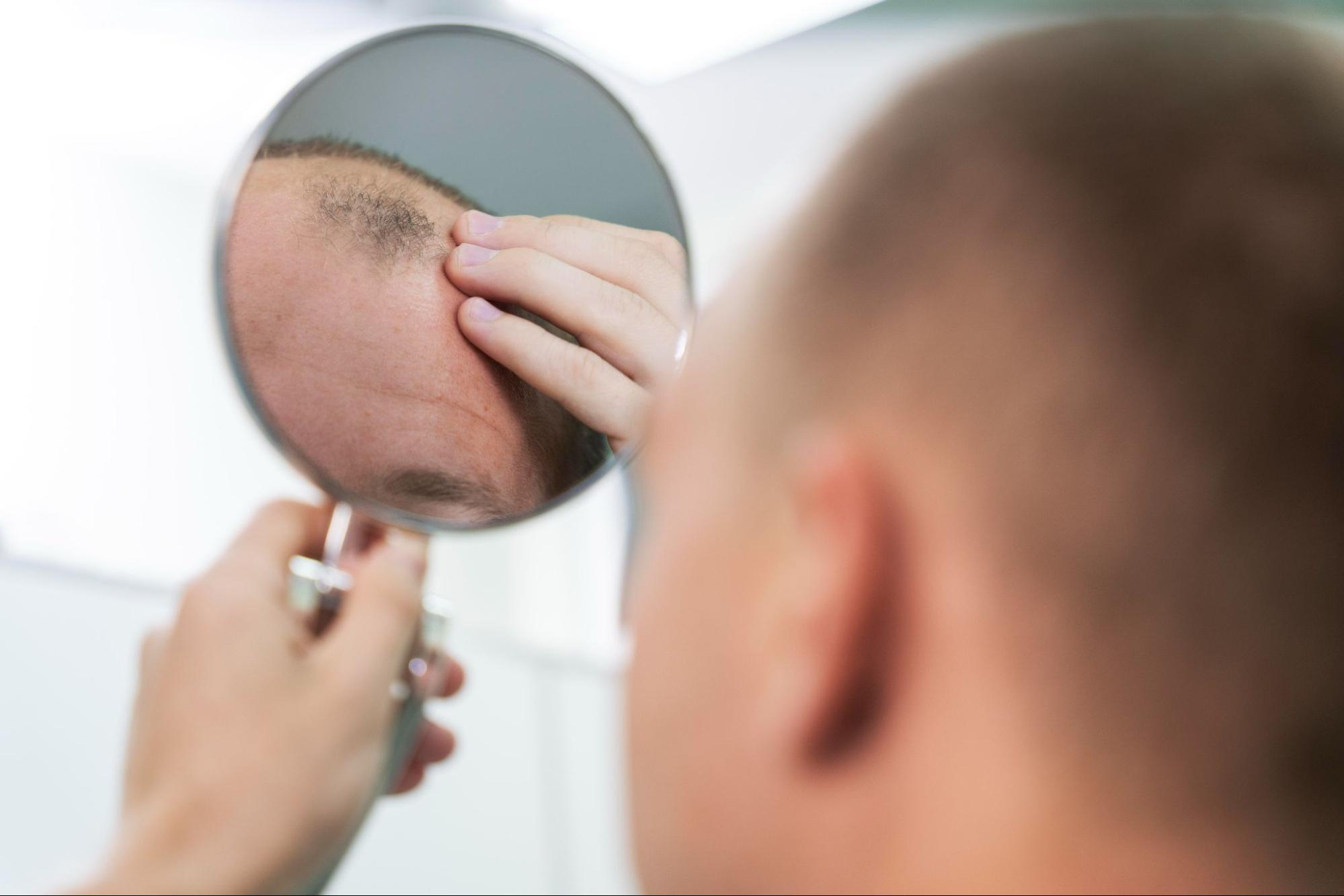 Alopecia คือ