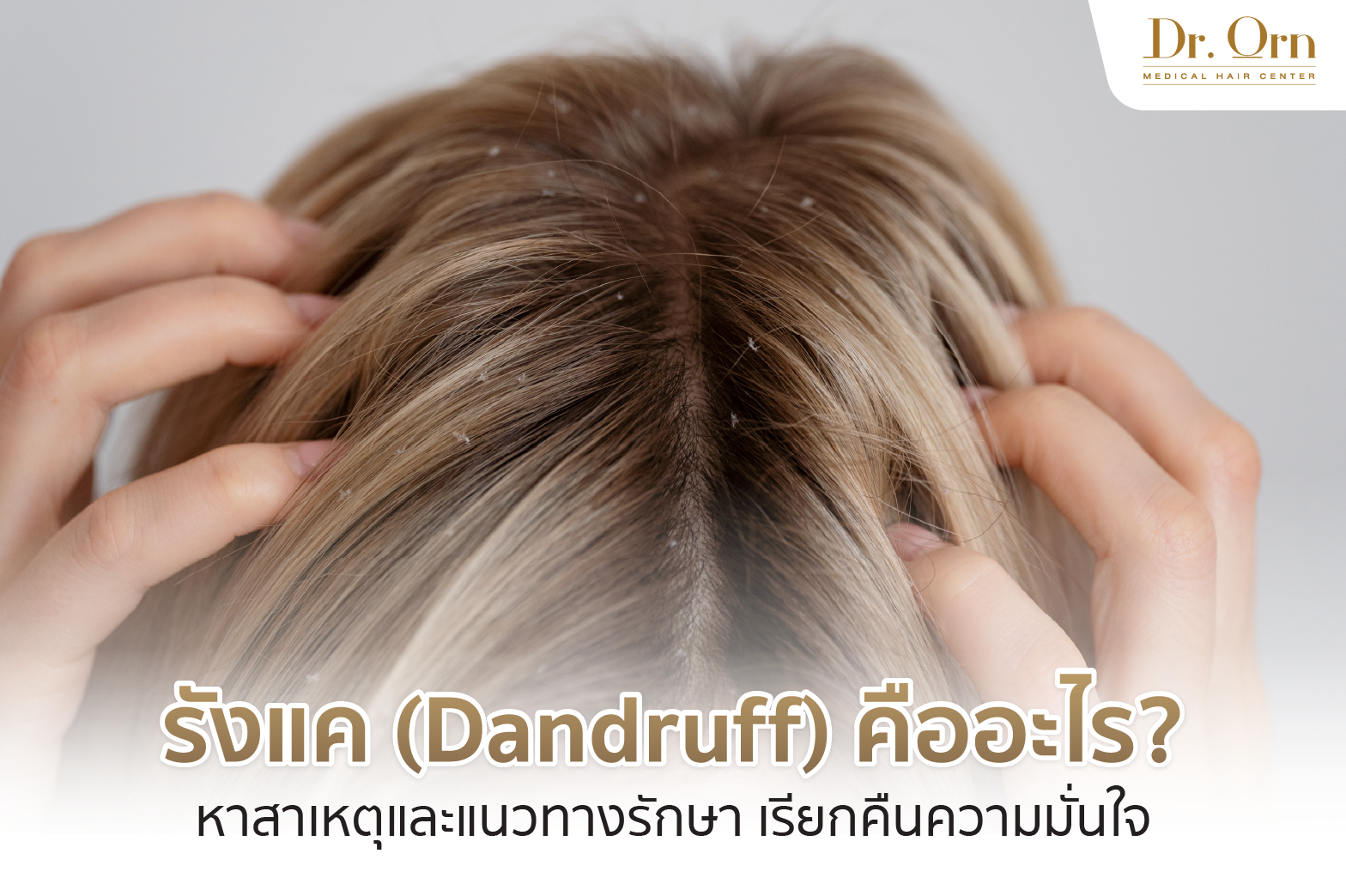 รังแค (Dandruff) คืออะไร? หาสาเหตุและแนวทางรักษา เรียกคืนความมั่นใจ