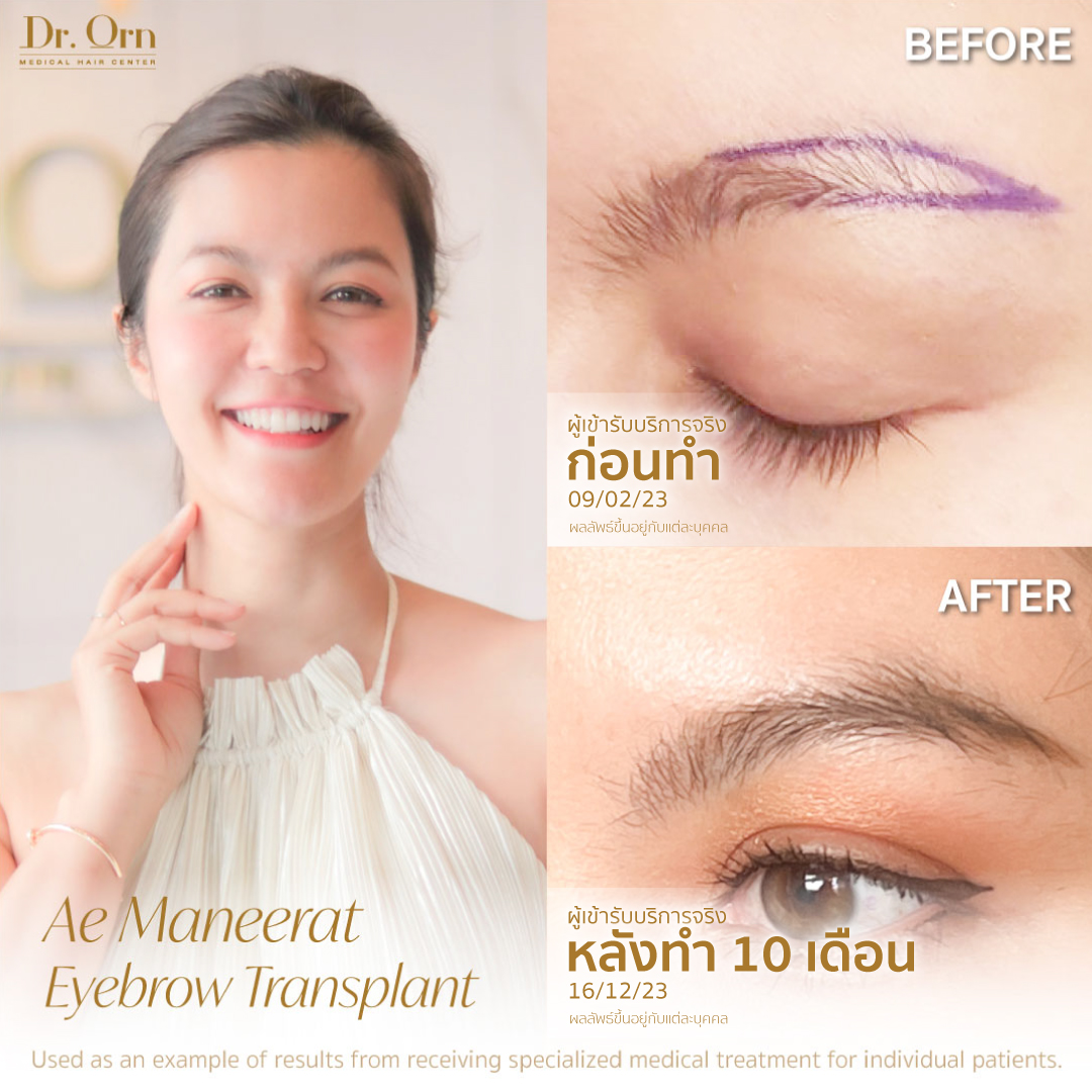 รีวิวการปลูกคิ้ว
