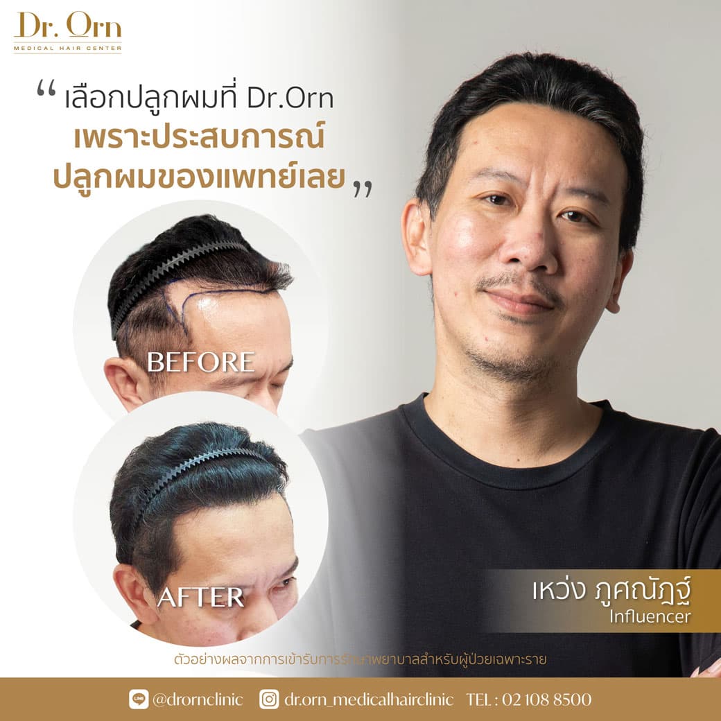 ข้อดีปลูกผม FUE