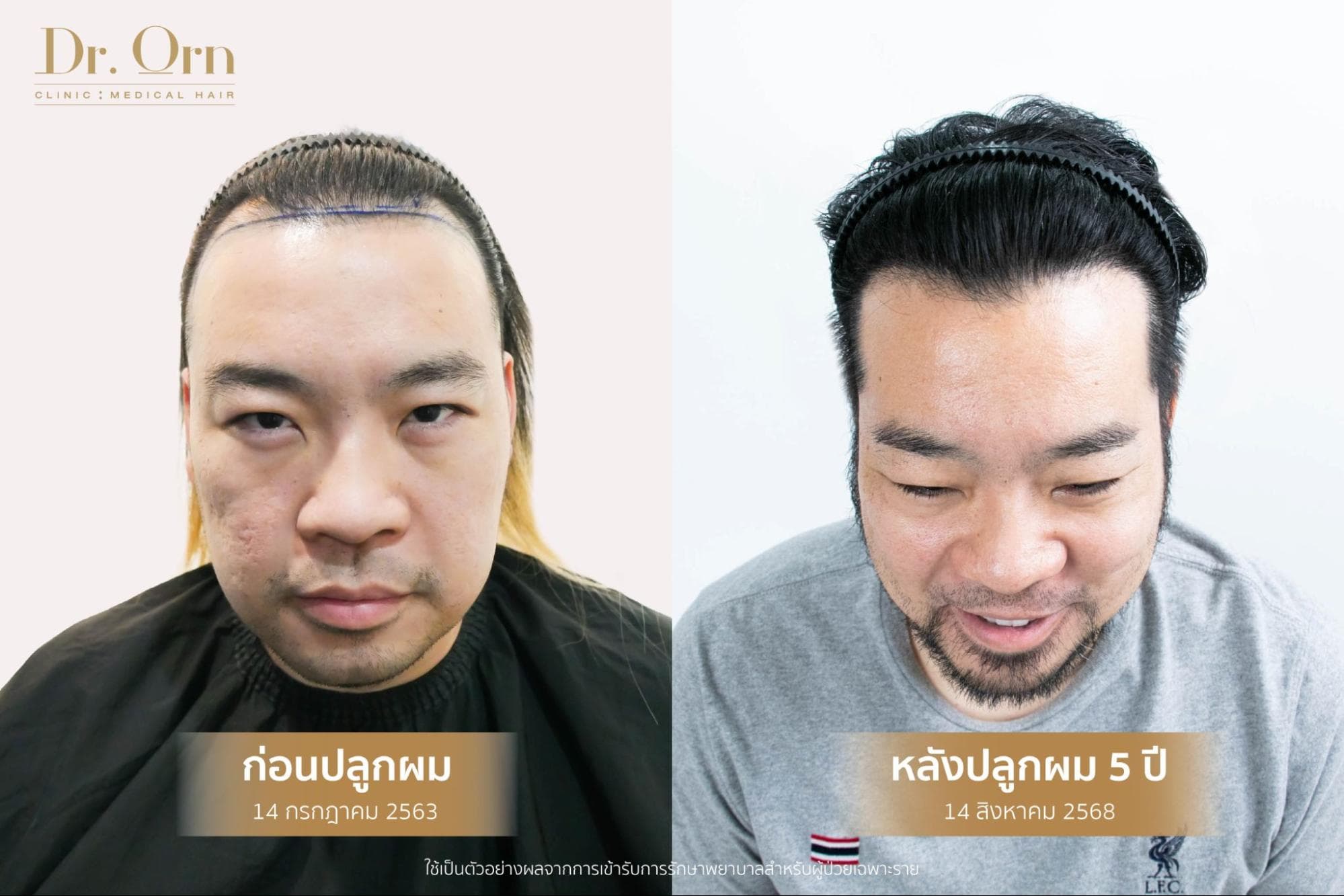 รีวิว fue1