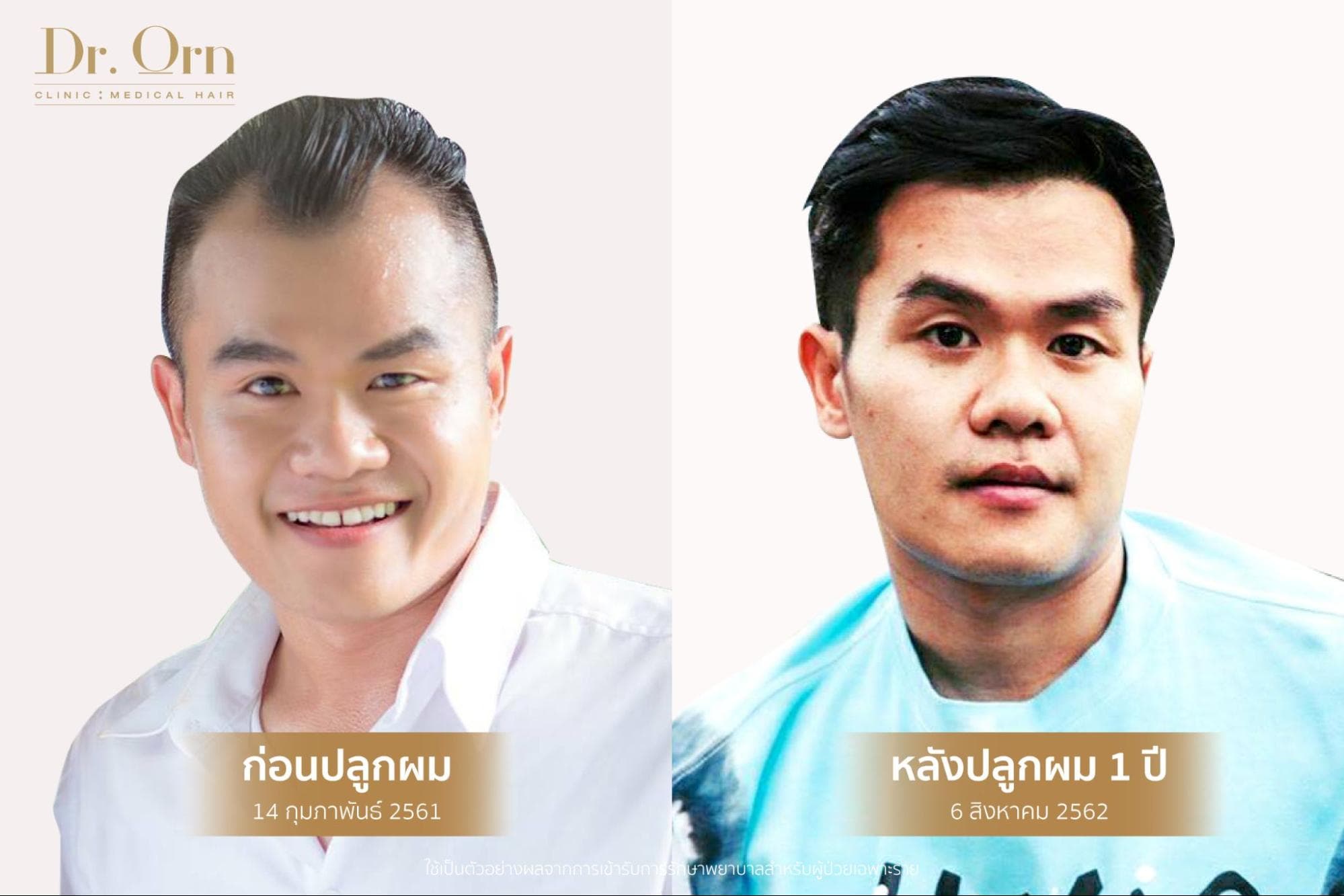 ผู้ที่เหมาะกับปลูกผม FUE