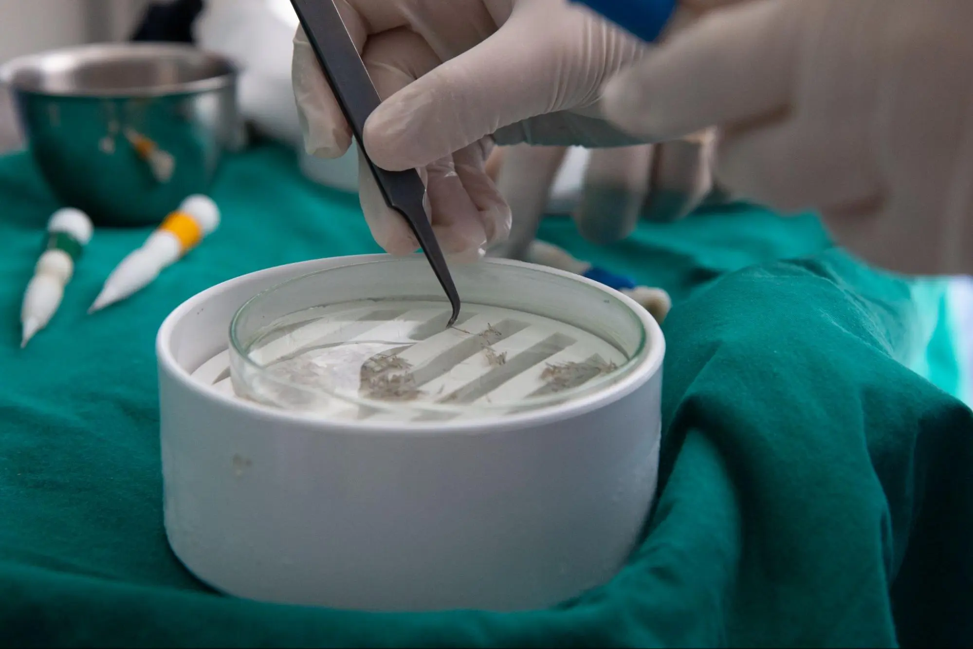 รักษาด้วยการปลูกผม