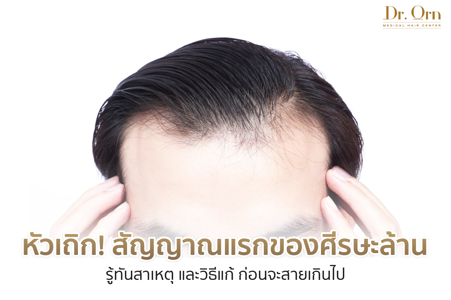 หัวเถิก สัญญาณแรกของศีรษะล้าน รู้ทันสาเหตุ และวิธีแก้ ก่อนจะสายเกินไป