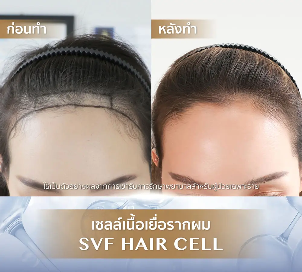 บำรุงรากผมไม่แข็งแรง