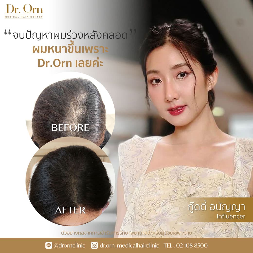 การปลูกผมผู้หญิง