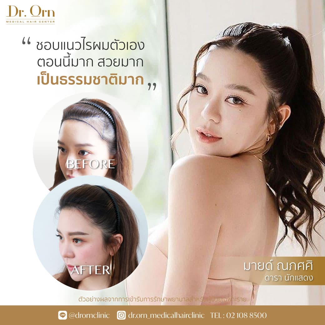รีวิวการปลูกผมผู้หญิง