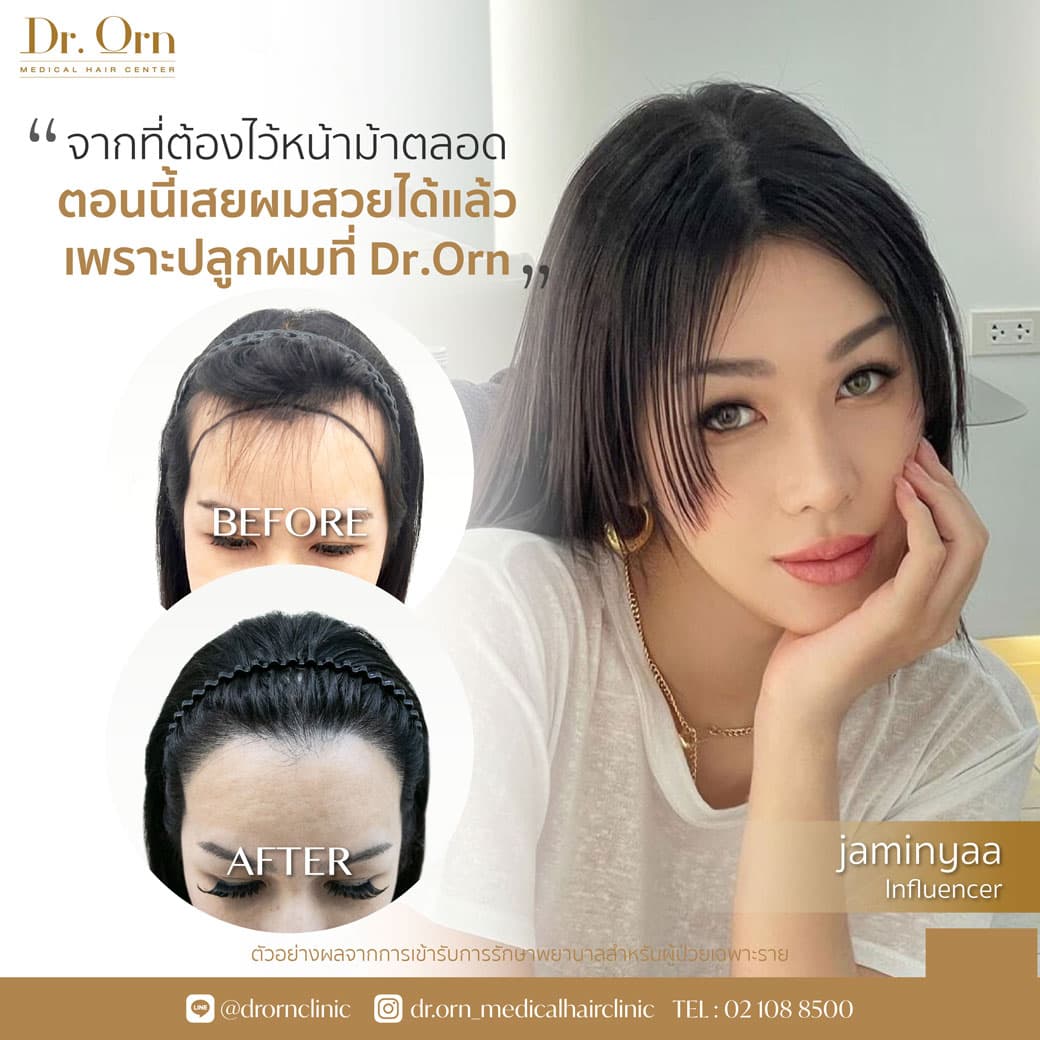 ปลูกไรผมผู้หญิง